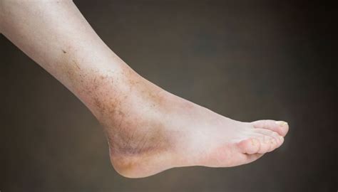 Swollen Ankle and Leg Causes, Treatments, and More