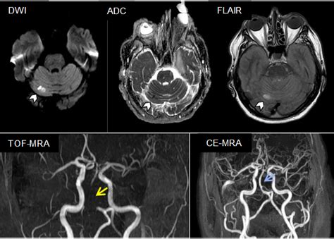 An uncommon pitfall in diagnosing basilar artery occlusion - European Stroke Organisation