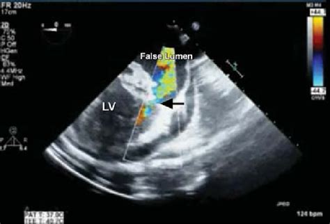 Transesophageal Echocardiogram With Color Flow Mapping Shows The Site