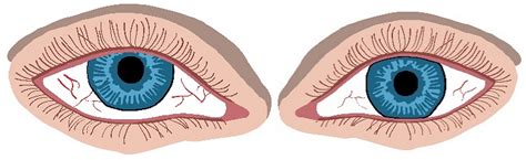 4th Nerve Palsy