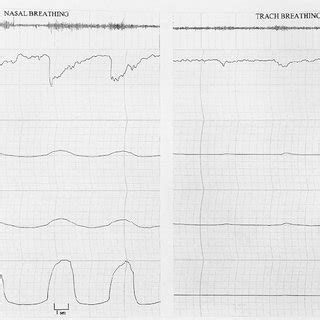 The Peak Phasic Genioglossus GG EMG Fell In All Five Patients After The