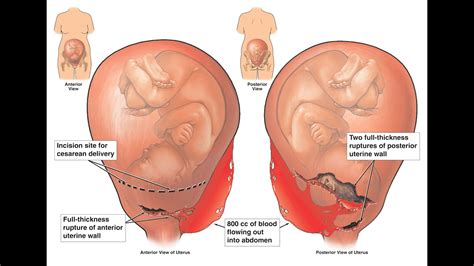 Uterine Rupture Malpractice - YouTube