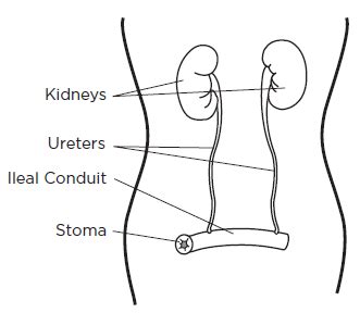 Ileal Conduit Anatomy