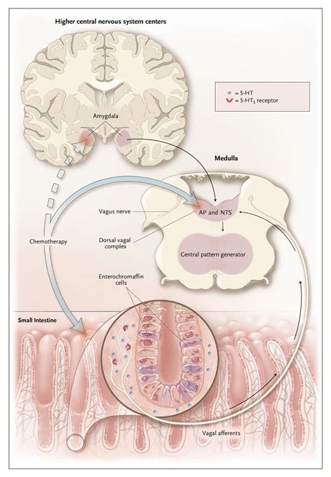 Chemotherapy Induced Nausea And Vomiting New England Journal Of Medicine