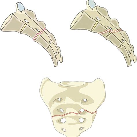 Sacral C2 Fracture C2 Fractures Indicate Bilateral Vertical Fractures Download Scientific