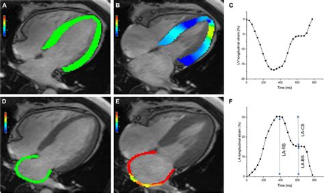 Cardiac Magnetic Resonance CMR Derived Left Ventricular And Atrial