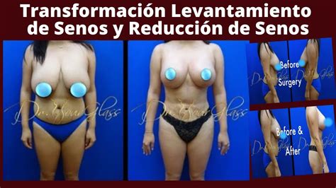 Levantamiento De Senos Reduccion De Senos Dr Cortes YouTube