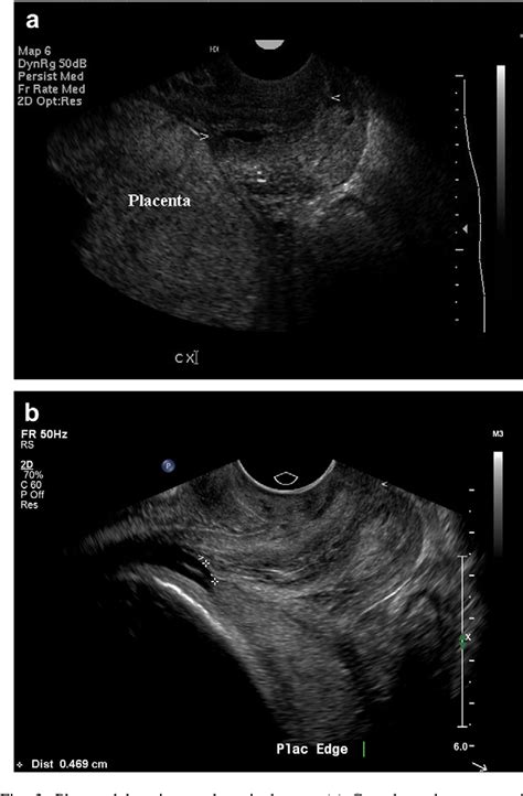 Figure 17 From Ultrasound Of The Placenta A Systematic Approach Part