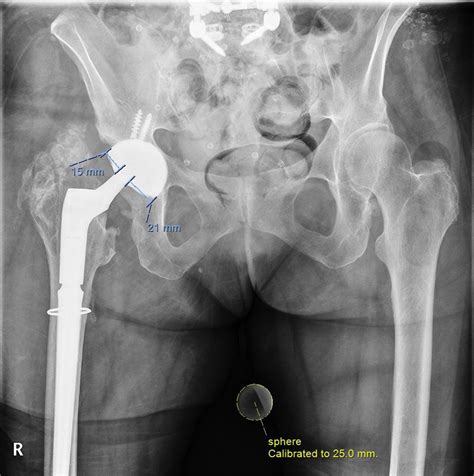 High Rate Of Early Intraprosthetic Dislocations Of Dual Mobility