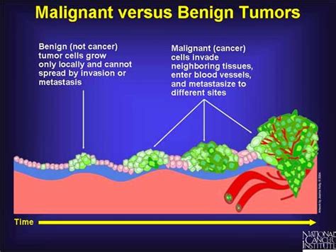 Beza Di Antara Ketumbuhan Tumor Dengan Kanser Story Of Health And Beauty