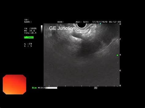 Gastroesophageal Junction Ultrasound