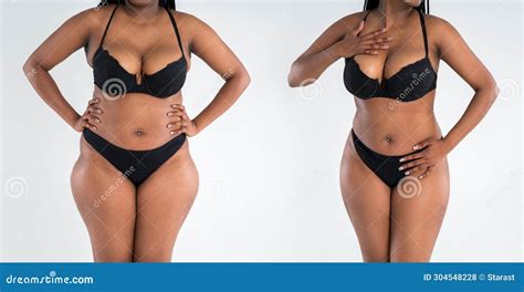 Tummy Tuck Fat Body Before And After Weight Loss And Liposuction On Gray Background Black