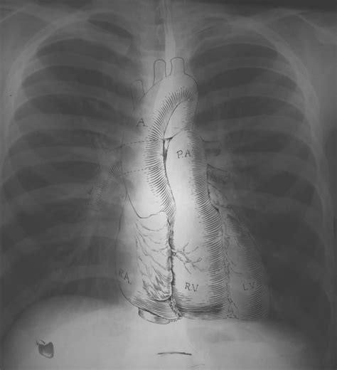 Normal Chest X-Ray • LITFL Medical Blog • Labelled Radiology