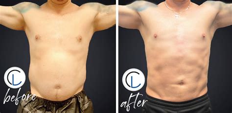 Liposuction In Men Chicago Liposuction By Lift Body Center