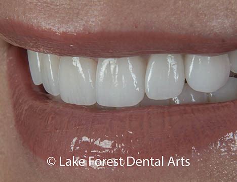 Front Tooth Crowns | How to make them disappear