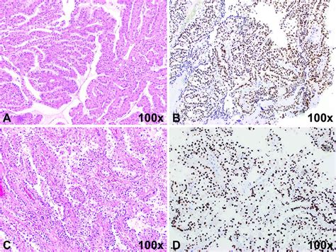 Diagnostic Approach In Tfe Rearranged Renal Cell Carcinoma A Multi