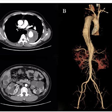 Radiographic Findings Of The Proband A Multi Slice Computed Tomography