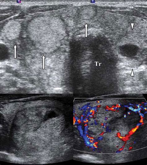 Multinodular Goiter Ultrasound