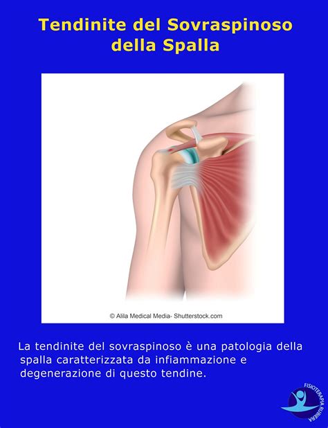 Tendinite Del Sovraspinoso Della Spalla Sintomi Ed Esercizi