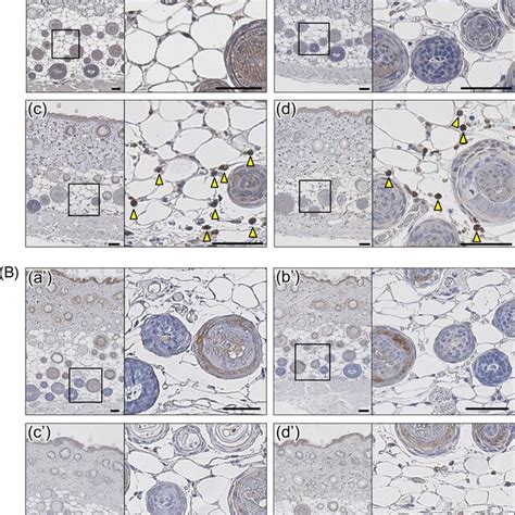 Immunohistochemical Analysis Of Myeloperoxidase A And Galectin B