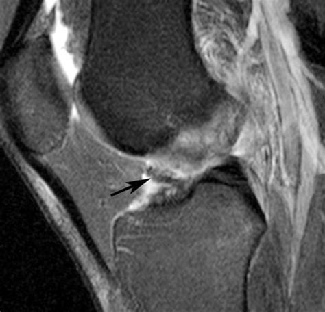 Cyclops Lesions That Occur In The Absence Of Prior Anterior Ligament