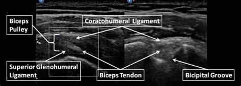 Shoulder Ultrasound Anatomy