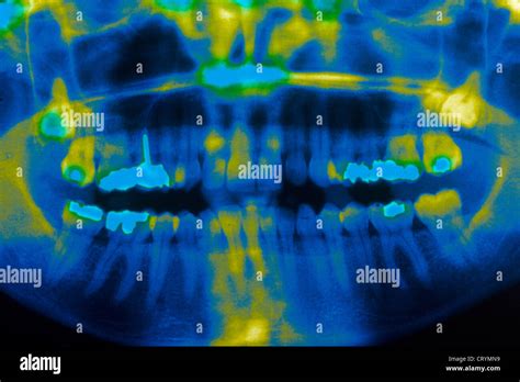 WISDOM TOOTH, X RAY Stock Photo - Alamy