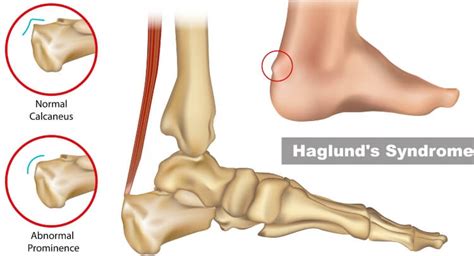 Haglund's Deformity Foot Care in Millsboro & Seaford, DE