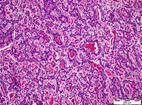 Pathology Outlines Yolk Sac Tumor