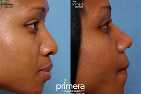 Black Rhinoplasty Before And After