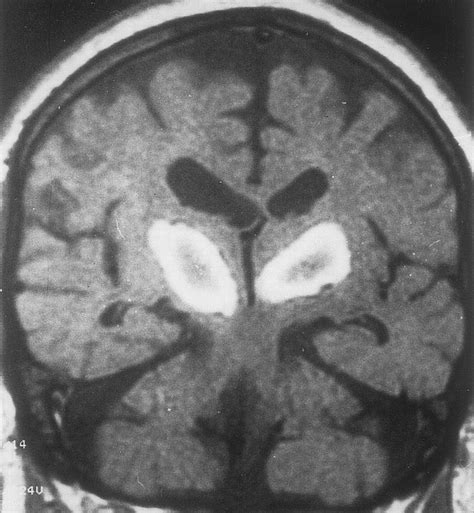 Thalamic Vascular Lesions Stroke