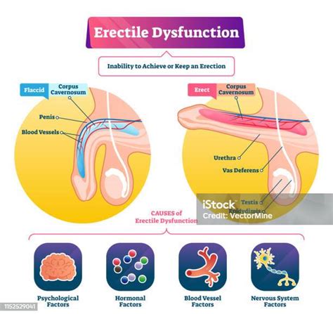 Erectile Dysfunction Vector Illustration Labeled Impotence Explain