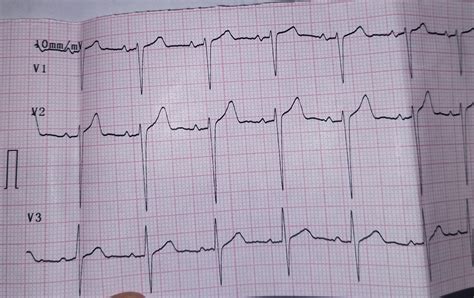 Relatively flat T waves : r/ECG