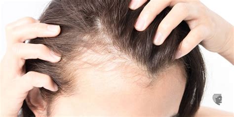 Is Inflammation In Your Body Causing Hair Loss Ahs India