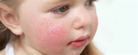 ¿cómo Se Trata La Dermatitis Atópica De Un Niño