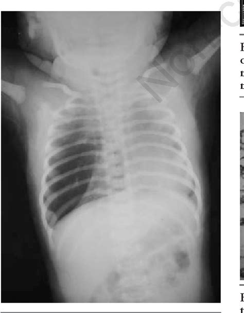 Figure From Congenital Lobar Emphysema Mimicking As Persistent