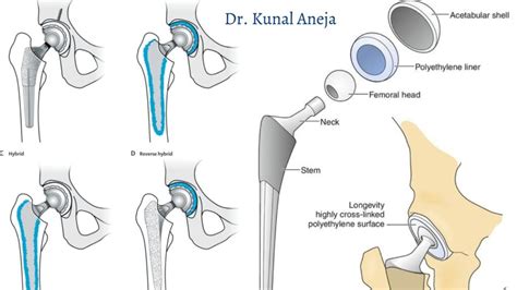 Hip Replacement Surgeons In New Delhi Dr Kunal Aneja