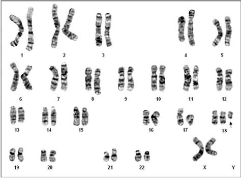 A Karyotype Of 47xxþi18p10 The Arrow Indicates A Supernumerary