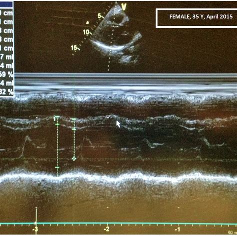 Parasternal long-axis echocardiogram view (PLAX view)normal systolic ...