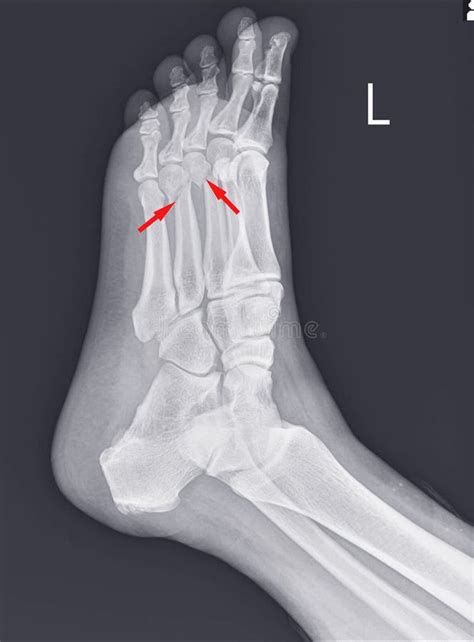 Film Ankle X Ray Radiograph Showing Heel Bone Broken Close Fracture