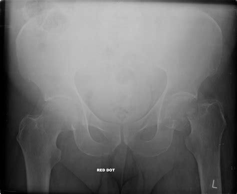 Subcapital Left Femoral Neck Fracture