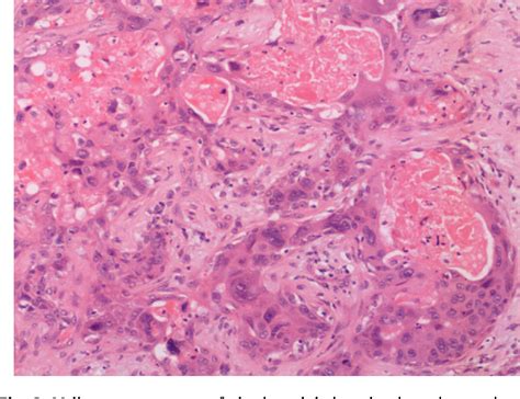 Figure From An Intracapsular Carcinoma Ex Pleomorphic Adenoma With