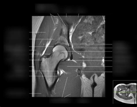 Label T1 Coronal MRI of Hip Diagram | Quizlet