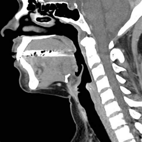 ct neck  ca nguyen