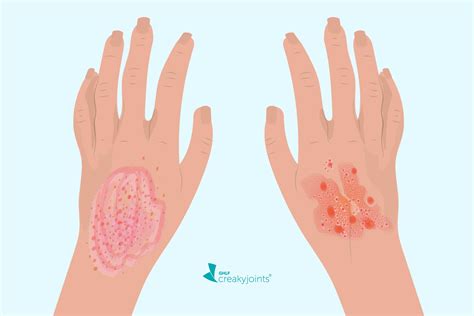 Eczema Vs Psoriasis Whats The Difference