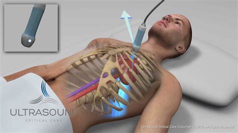 Parasternal Long Axis Ultrasound