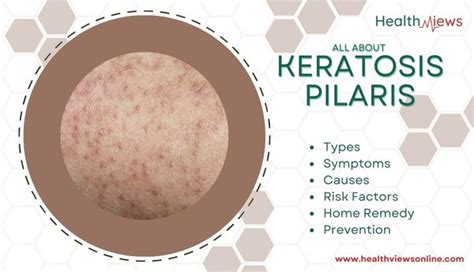 All You Need To Know About Keratosis Pilaris