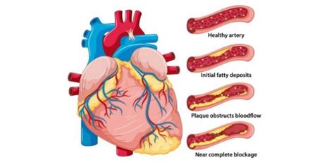 5 Makanan Penyebab Penumpukan Plak Di Arteri Yang Para Ahli Ingin Anda