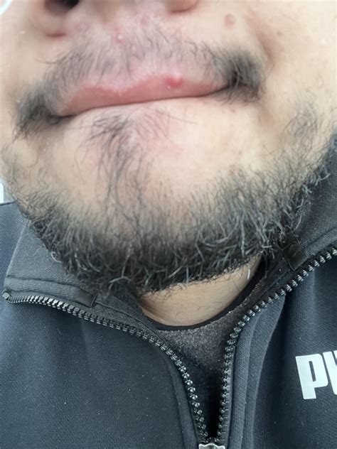 how to get rid of bump on your lip 2