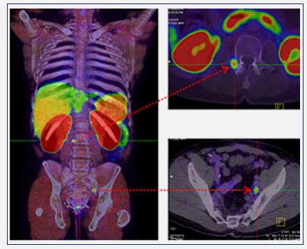 An Introduction To PET CT Scans